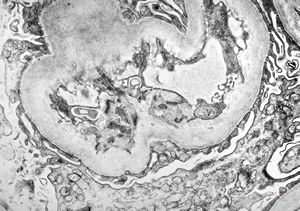  F,31y. | initial glomerular hyalinosis and sclerosis